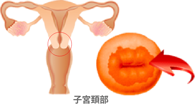 子宮頸部の細胞診（液状化検体・LBC法）